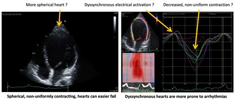 what is paf in cardiology.